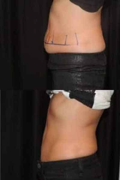 HIEMT Muscle Toning West Thurrock