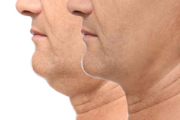 HIFU - Breakthrough in Anti - ageing 2 hifu results West Thurrock