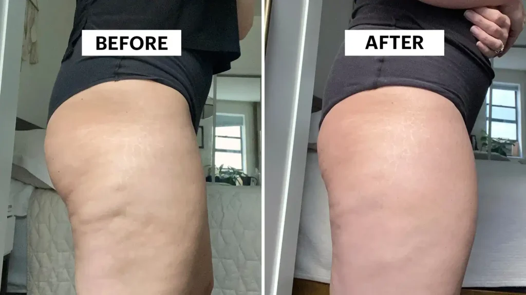 Sculpting Your Bum: Can Toning Exercises Really Reduce Cellulite? 1 Do Toning Exercise West Thurrock Really Tackle Cellulite?