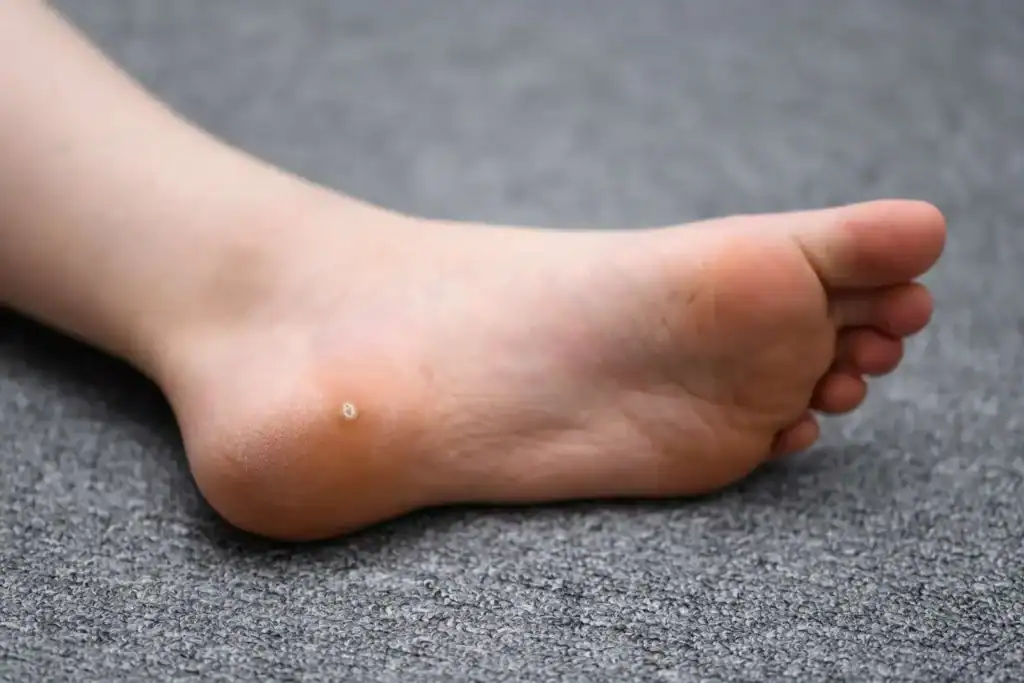 Cryotherapy For Warts And Also Verrucas 2 Image of verruca on the bottom of the foot that able to be treated with Cryotherapy West Thurrock
