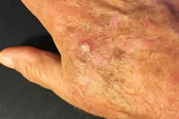 Image of Actinic keratoses West Thurrock on a person hand