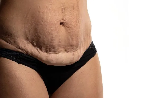 The science behind skin tightening West Thurrock picture of a woman's sagging skin on the stomach